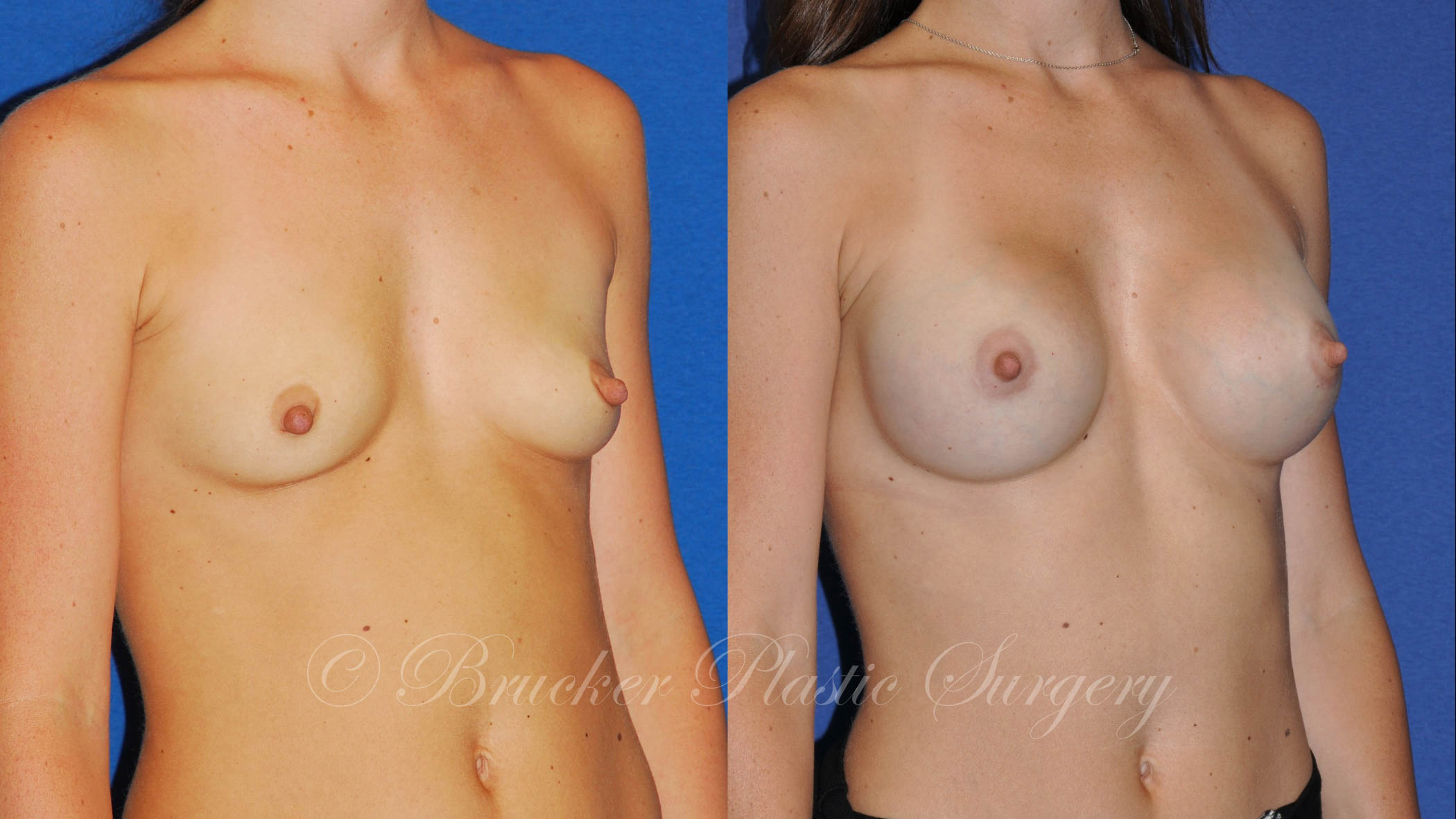 Patient 6c Breast Augmentation Before and After