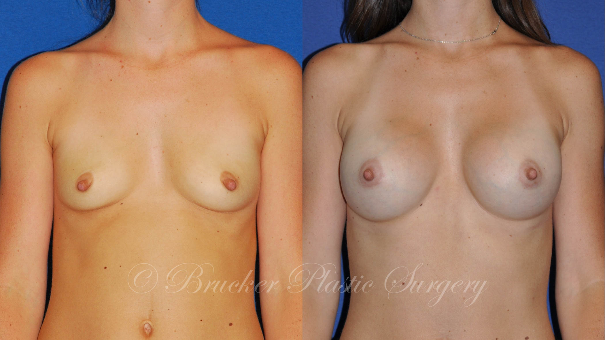 Patient 6a Breast Augmentation Before and After