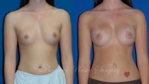 Patient 1c Breast Augmentation Before and After