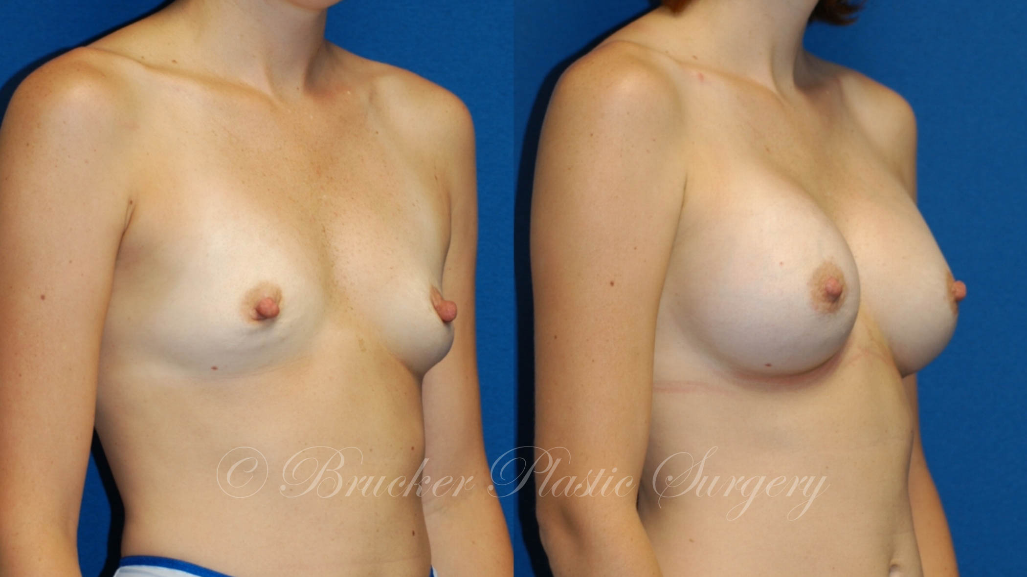 Patient 2b Breast Augmentation Before and After