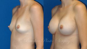 Patient 2c Breast Augmentation Before and After