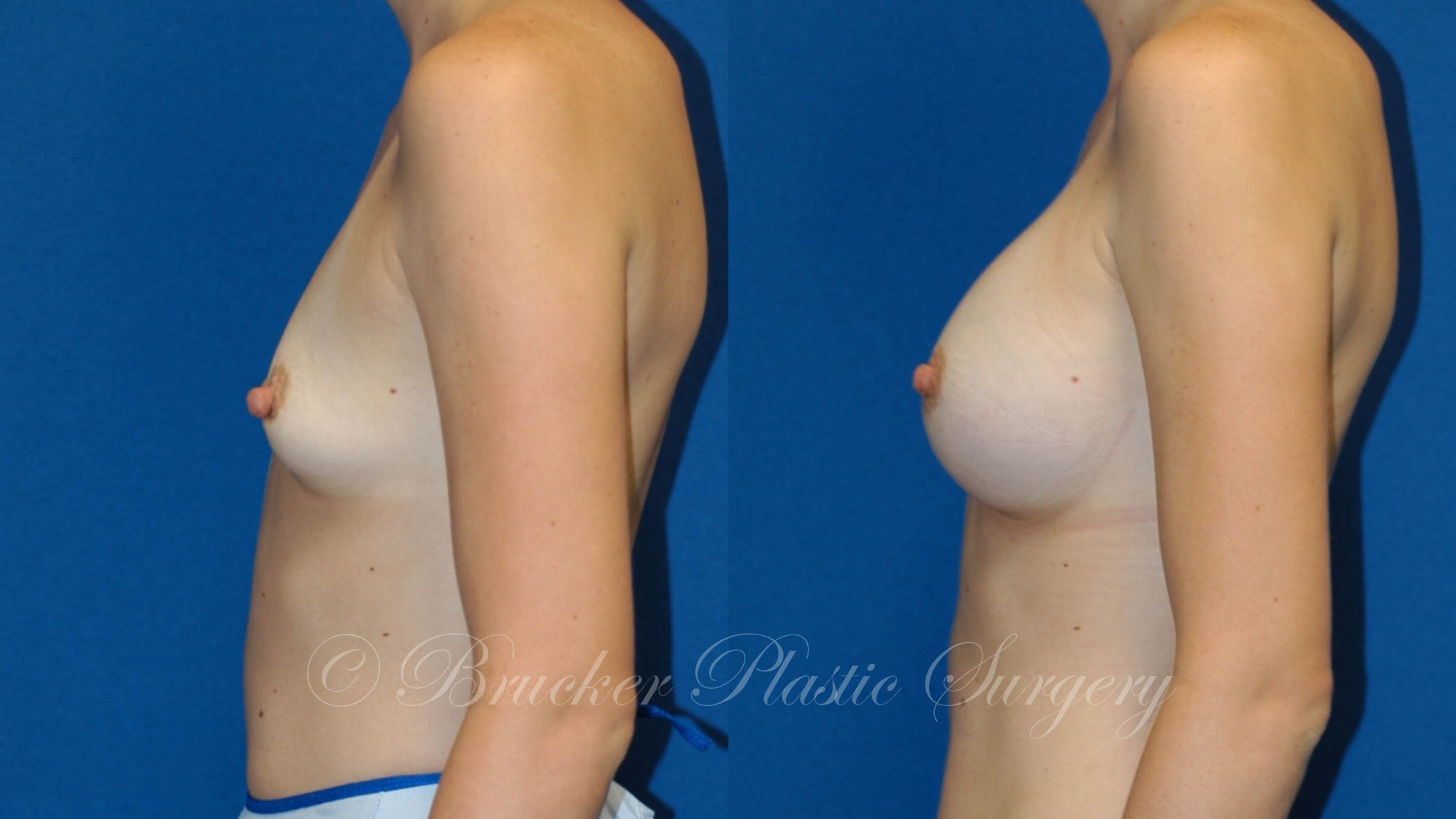 Patient 2d Breast Augmentation Before and After