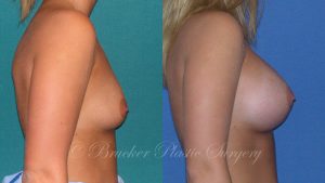 Patient 3b Breast Augmentation Before and After