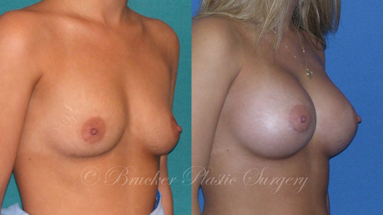Patient 3c Breast Augmentation Before and After