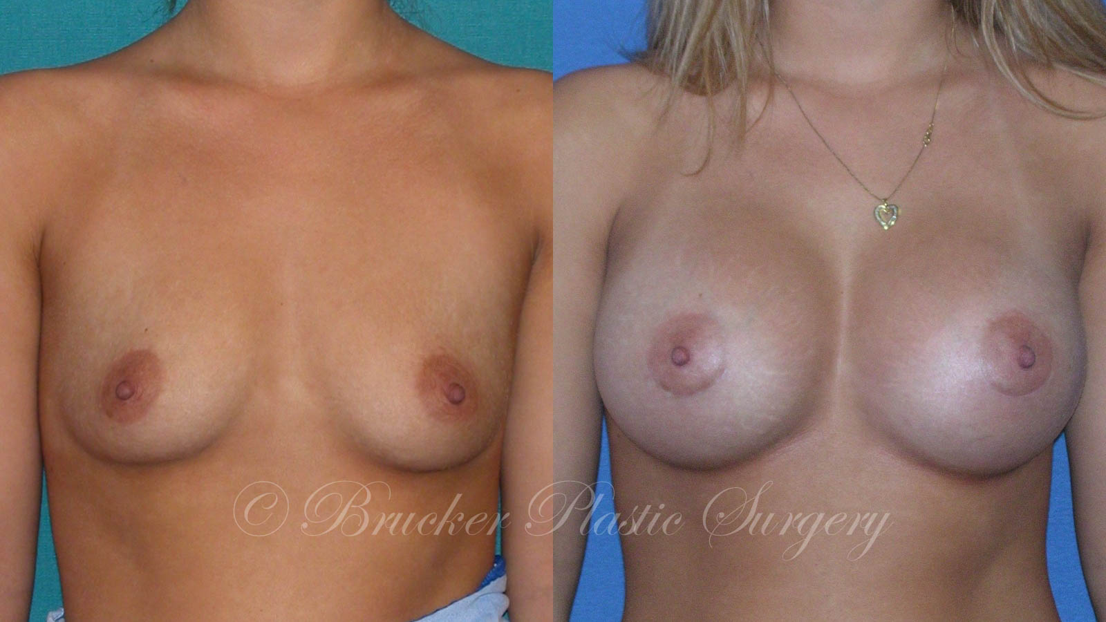 Patient 3a Breast Augmentation Before and After
