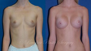 Patient 4a Breast Augmentation Before and After