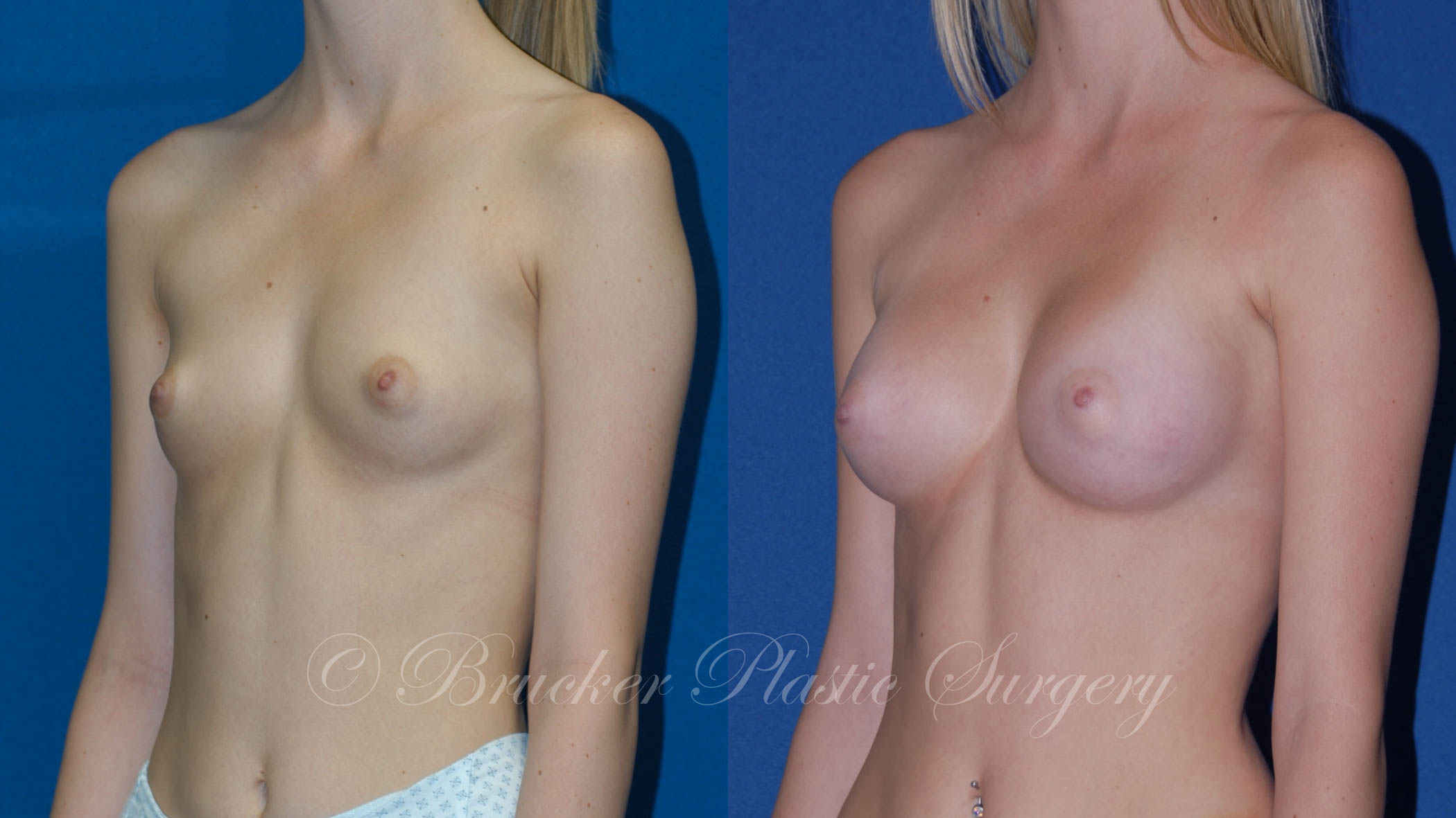 Patient 4b Breast Augmentation Before and After
