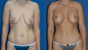 Patient 4a Breast Lift with Augmentation Before and After