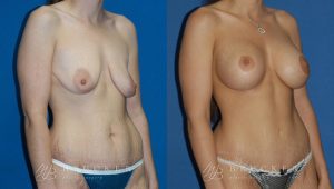 Patient 4b Breast Lift with Augmentation Before and After