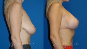 Patient 5a Breast Lift with Augmentation Before and After