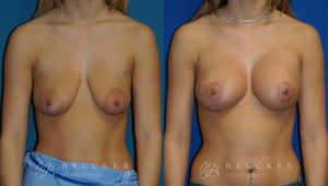 Patient 6b Breast Lift with Augmentation Before and After