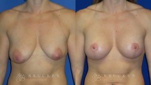 Patient 7a Breast Lift with Augmentation Before and After