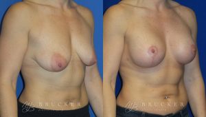 Patient 7b Breast Lift with Augmentation Before and After