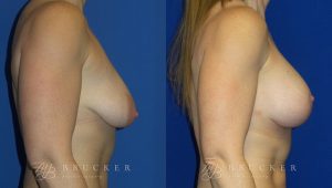 Patient 7c Breast Lift with Augmentation Before and After