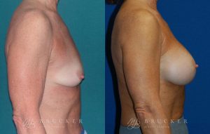 Patient 1a Breast Lift with Augmentation Before and After