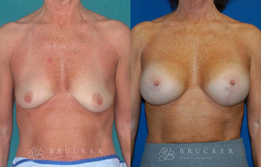 Patient 1b Breast Lift with Augmentation Before and After