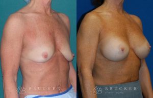 Patient 1c Breast Lift with Augmentation Before and After