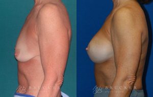 Patient 1d Breast Lift with Augmentation Before and After