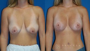 Patient 2c Breast Lift with Augmentation Before and After