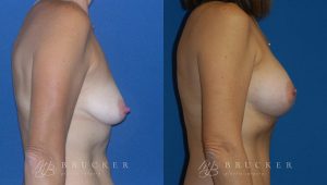 Patient 3a Breast Lift with Augmentation Before and After