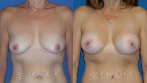 Patient 3b Breast Lift with Augmentation Before and After