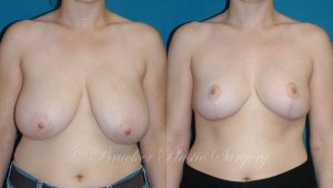 Patient 3a Breast Reduction Before and After