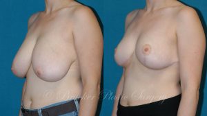 Patient 3b Breast Reduction Before and After