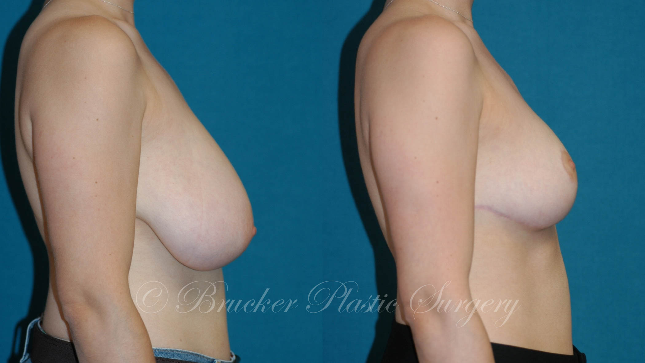 Breast Reduction Del Mar Patient 1.2