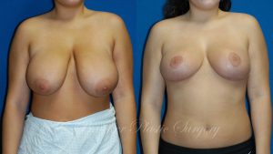 Patient 1a Breast Reduction Before and After