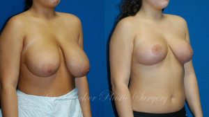 Patient 1b Breast Reduction Before and After