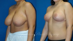 Patient 1c Breast Reduction Before and After