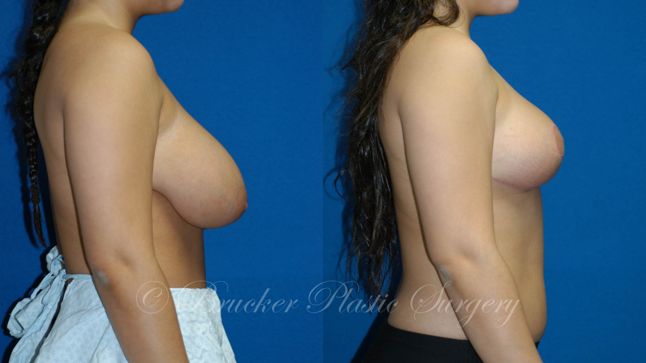 Patient 1d Breast Reduction Before and After