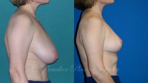 Patient 2a Breast Reduction Before and After