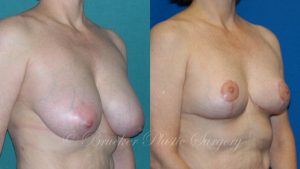 Patient 2b Breast Reduction Before and After