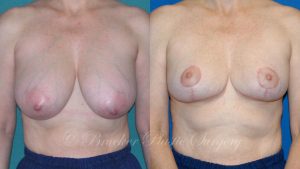 Patient 2c Breast Reduction Before and After