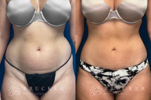 DrBrucker_LaJolla_B&A_Liposuction_Patient-1-Front