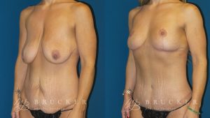 DrBrucker_LaJolla_Body_Lift_B&A_Patient5_Oblique Left