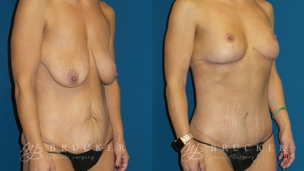 DrBrucker_LaJolla_Mommy_Makeover_B&A_Patient6_Oblique Right