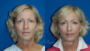 Patient 3a Facelift Before and After