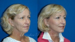 Patient 3b Facelift Before and After