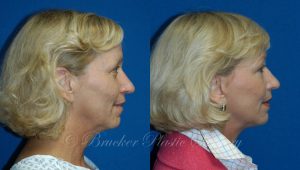 Patient 3c Facelift Before and After