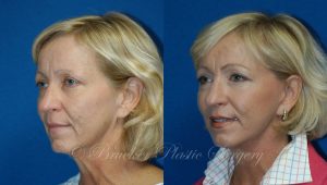 Patient 3d Facelift Before and After