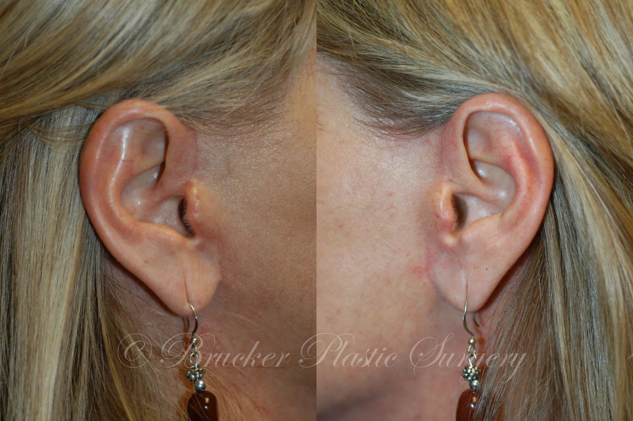 Patient 3e Facelift Before and After