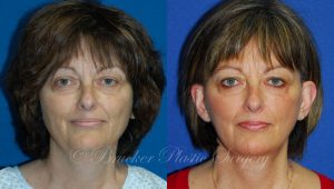 Patient 1a Facelift Before and After