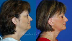 Patient 1b Facelift Before and After