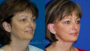 Patient 1c Facelift Before and After