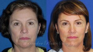 Patient 2a Facelift Before and After