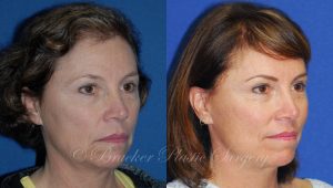 Patient 2b Facelift Before and After