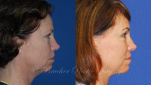 Patient 2c Facelift Before and After