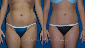 Patient 3a Liposuction Before and After